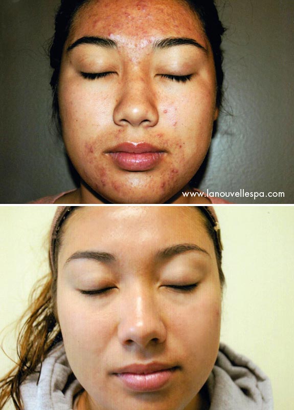 acne treatments before and after by la nouvelle medical spa, oxnard