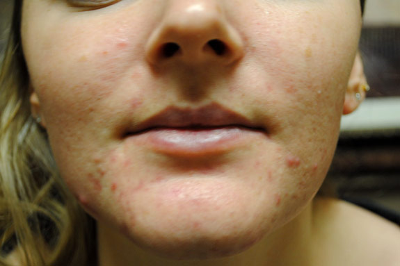 acne treatments before by la nouvelle medical spa oxnard