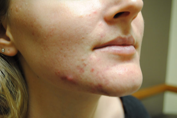 acne treatments before by la nouvelle medical spa oxnard