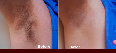 laser Hair Removal - Armpit