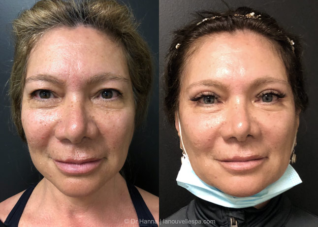 upper blepharoplasty eyelid surgery before and after photos by dr hanna at la nouvelle medical spa oxnard ventura