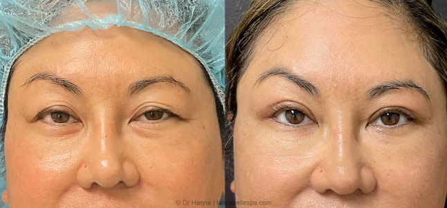 Asian Blepharoplasty upper Eyelid Surgery before after photos Ventura County, Dr. Hanna La Nouvelle Medical Spa, Oxnard