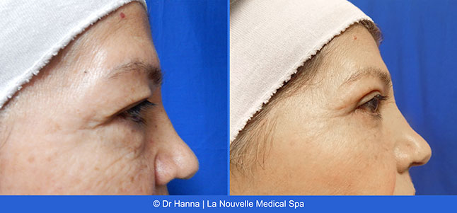 Blepharoplasty upper and lower Eyelid Surgery before after photos Ventura County, Dr. Hanna La Nouvelle Medical Spa, Oxnard