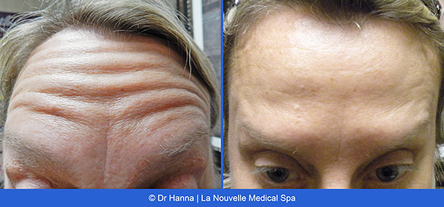 Botox, Xeomin before after photos Ventura County, La Nouvelle Medical Spa, Oxnard, Dr. Antoine Hanna, Dr. Jack Shenouda 