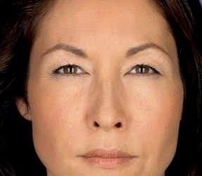 Botox Frown lines - after