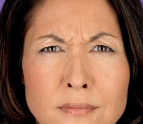 Botox Frown lines - before