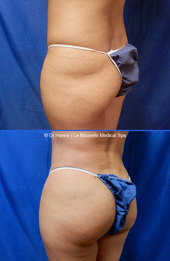 brazilian butt lift by dr. hanna la nouvelle medical spa oxnard