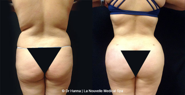 Brazilian butt lift with liposuction before after Ventura County Dr. Hanna La Nouvelle Medical Spa, Oxnard