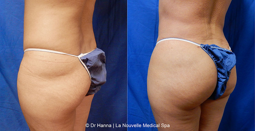 Brazilian butt lift with liposuction before after Ventura County Dr. Hanna La Nouvelle Medical Spa, Oxnard