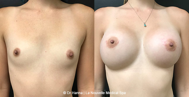 Breast augmentation before and after photos Ventura County, boob job with silicone implants by Dr. Hanna, La Nouvelle Medical Spa