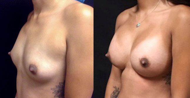 Breast augmentation before and after photos Ventura County, boob job with silicone implants by Dr. Hanna, La Nouvelle Medical Spa, 51 sideview