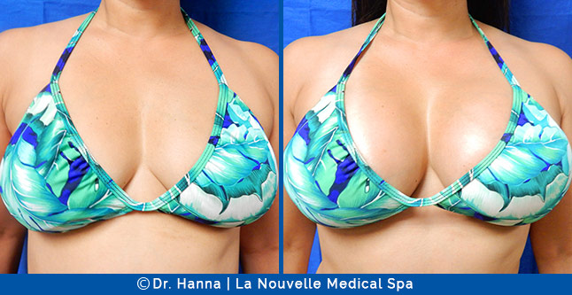 Breast augmentation before and after photos Ventura County, boob job with silicone implants by Dr. Hanna, La Nouvelle Medical Spa, 52