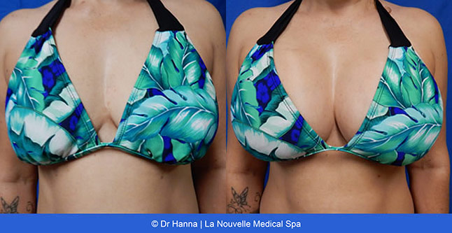 Breast augmentation before and after photos Ventura County, boob job with silicone implants by Dr. Hanna, La Nouvelle Medical Spa, frontview