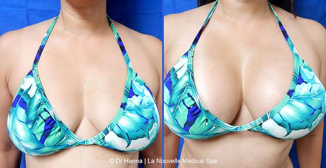 Breast augmentation before and after photos Ventura County, boob job with silicone implants by Dr. Hanna, La Nouvelle Medical Spa, 12