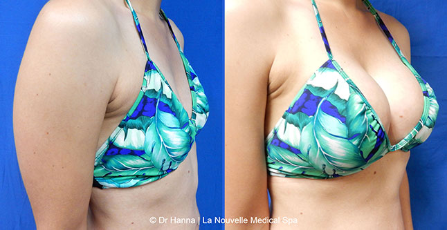 Breast augmentation before and after photos Ventura County, boob job with silicone implants by Dr. Hanna, La Nouvelle Medical Spa, 13