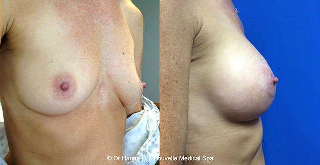 Breast augmentation before and after photos Ventura County, boob job with silicone implants by Dr. Hanna, La Nouvelle Medical Spa, 14