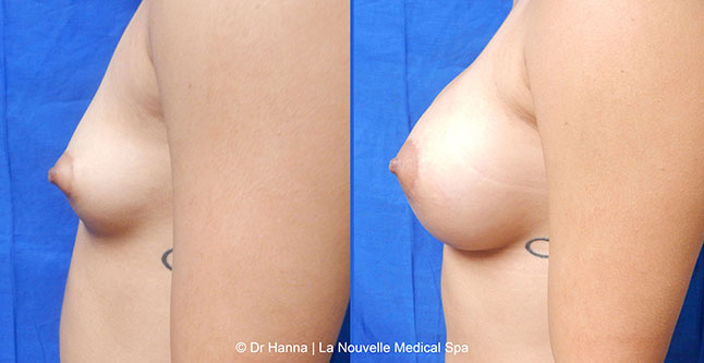 Breast augmentation before and after photos Ventura County, boob job with silicone implants by Dr. Hanna, La Nouvelle Medical Spa, 16