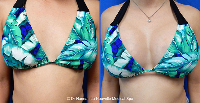 Breast augmentation before and after photos Ventura County, boob job with silicone implants by Dr. Hanna, La Nouvelle Medical Spa, 17