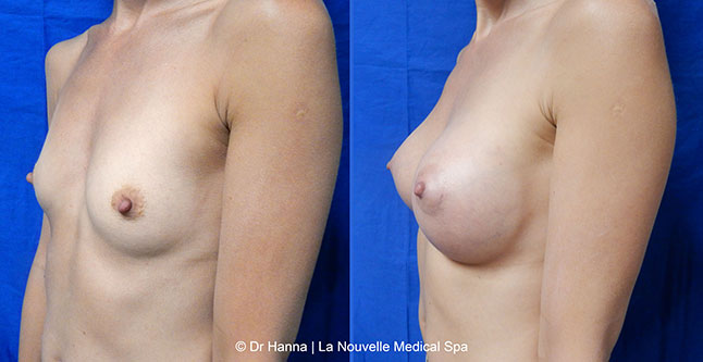 Breast augmentation before and after photos Ventura County, boob job with silicone implants by Dr. Hanna, La Nouvelle Medical Spa2