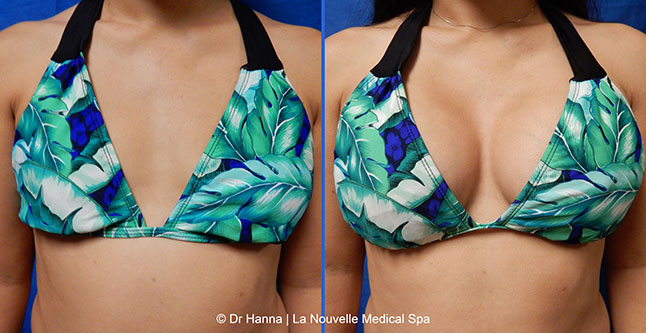 Breast augmentation before and after photos Ventura County, boob job with silicone implants by Dr. Hanna, La Nouvelle Medical Spa, 21