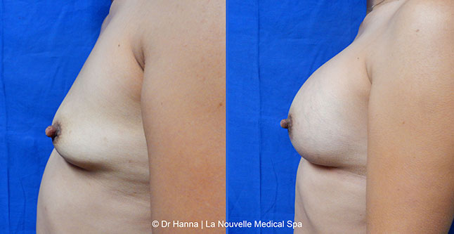 Breast augmentation before and after photos Ventura County, boob job with silicone implants by Dr. Hanna, La Nouvelle Medical Spa, 23