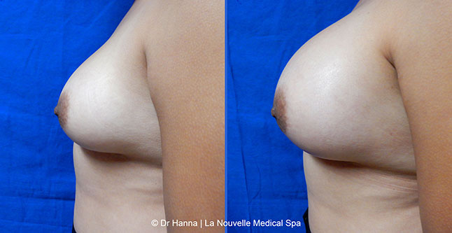 Breast augmentation before and after photos Ventura County, boob job with silicone implants by Dr. Hanna, La Nouvelle Medical Spa, 24
