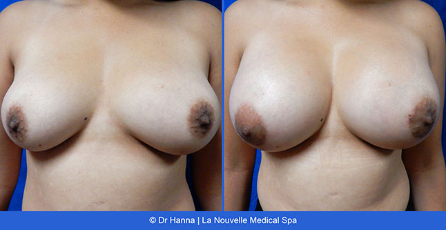 Breast augmentation before and after photos Ventura County, boob job with silicone implants by Dr. Hanna, La Nouvelle Medical Spa, 25