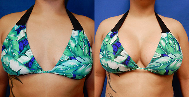 Breast augmentation before and after photos Ventura County, boob job with silicone implants by Dr. Hanna, La Nouvelle Medical Spa, 26