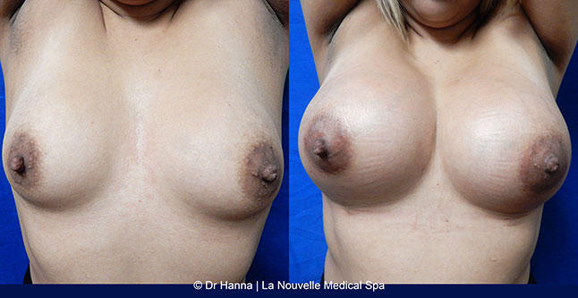Breast augmentation before and after photos Ventura County, boob job with silicone implants by Dr. Hanna, La Nouvelle Medical Spa, 27