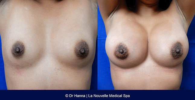 Breast augmentation before and after photos Ventura County, boob job with silicone implants by Dr. Hanna, La Nouvelle Medical Spa, 28
