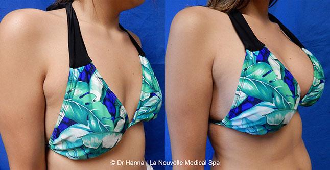 Breast augmentation before and after photos Ventura County, boob job with silicone implants by Dr. Hanna, La Nouvelle Medical Spa, 29