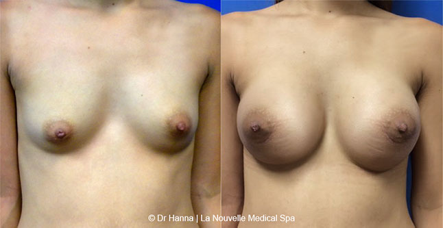 Breast augmentation before and after photos Ventura County, boob job with silicone implants by Dr. Hanna, La Nouvelle Medical Spa, 3