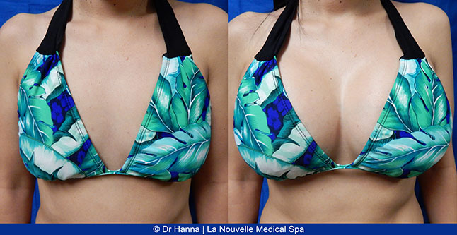 Breast augmentation before and after photos Ventura County, boob job with silicone implants by Dr. Hanna, La Nouvelle Medical Spa, 30