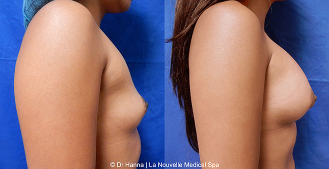 Breast augmentation before and after photos Ventura County, boob job with silicone implants by Dr. Hanna, La Nouvelle Medical Spa, 31