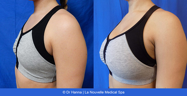Breast augmentation before and after photos Ventura County, boob job with silicone implants by Dr. Hanna, La Nouvelle Medical Spa, 32