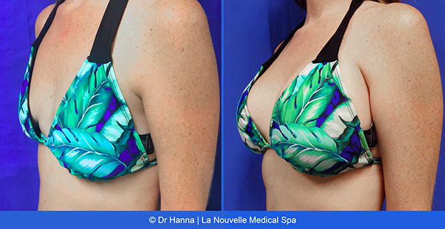 Breast augmentation before and after photos Ventura County, boob job with silicone implants by Dr. Hanna, La Nouvelle Medical Spa, 33