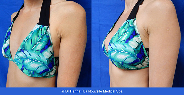 Breast augmentation before and after photos Ventura County, boob job with silicone implants by Dr. Hanna, La Nouvelle Medical Spa, 34