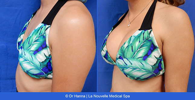 Breast augmentation before and after photos Ventura County, boob job with silicone implants by Dr. Hanna, La Nouvelle Medical Spa, 35