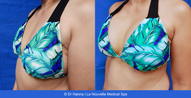 Breast augmentation before and after photos Ventura County, boob job with silicone implants by Dr. Hanna, La Nouvelle Medical Spa, 36