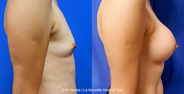 Breast augmentation before and after photos Ventura County, boob job with silicone implants by Dr. Hanna, La Nouvelle Medical Spa, 4