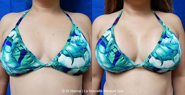 Breast augmentation before and after photos Ventura County, boob job with silicone implants by Dr. Hanna, La Nouvelle Medical Spa, 8