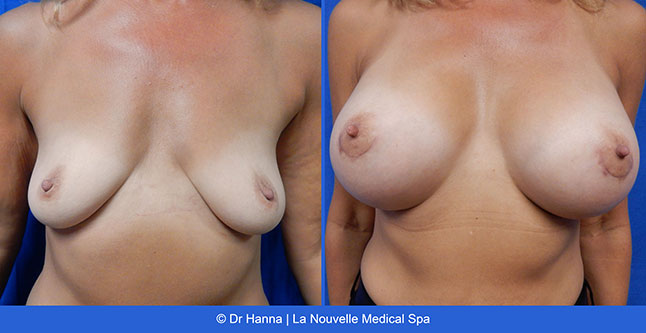 Breast augmentation before and after photos Ventura County, boob job with silicone implants by Dr. Hanna, La Nouvelle Medical Spa, 22