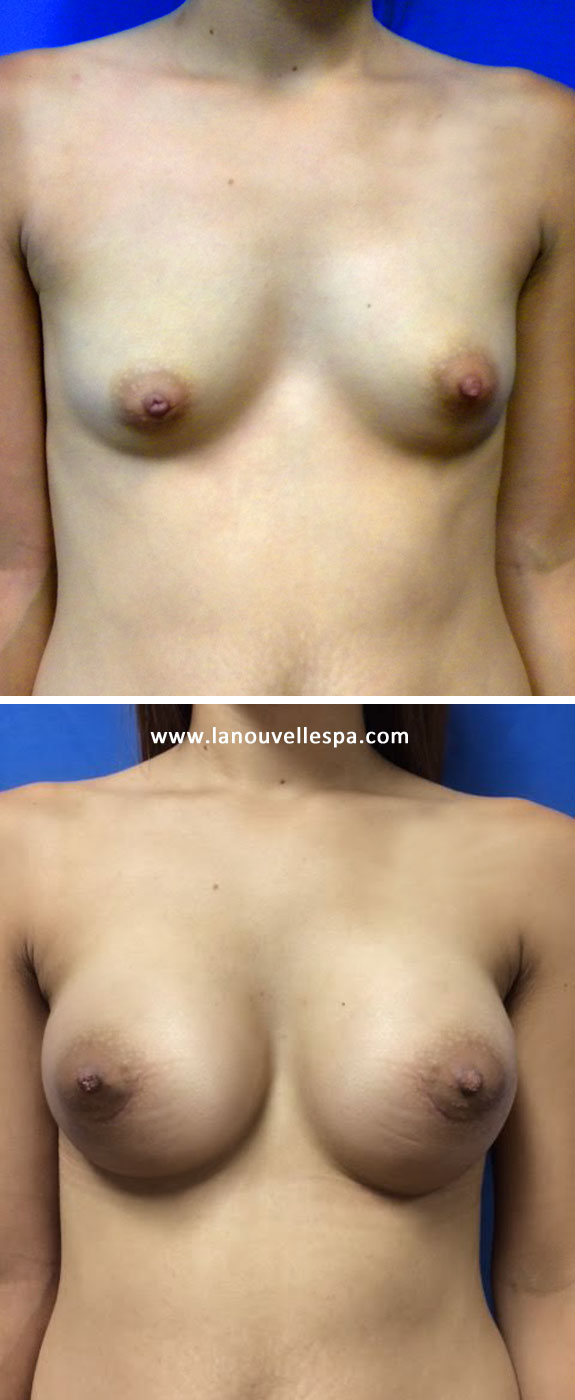 silicone implants breast augmentation before after oxnard