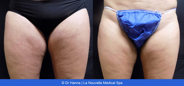 CoolSculpting before and after photos Ventura County La Nouvelle Medical Spa, Oxnard
