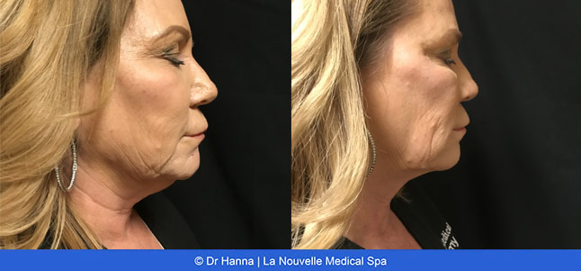 CoolSculpting before and after photos Ventura County La Nouvelle Medical Spa, Oxnard