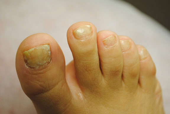 fungus toenail treatments by laser genesis before photo