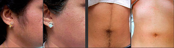 Laser Hair Removal Images