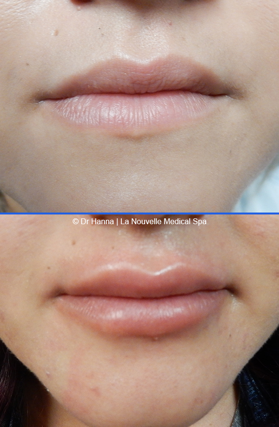 lip enhancement before and after with juvederm and volbella, oxnard