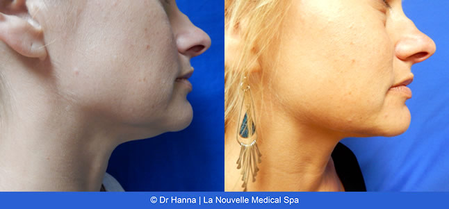 kybella injections for double chin before after photos, La Nouvelle Medical Spa, Oxnard, Ventura County