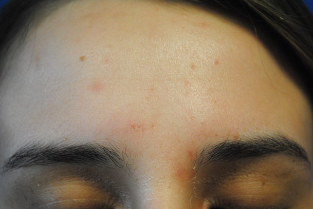 la nouvelle10 chemical peel medical spa oxnard forehead day3 